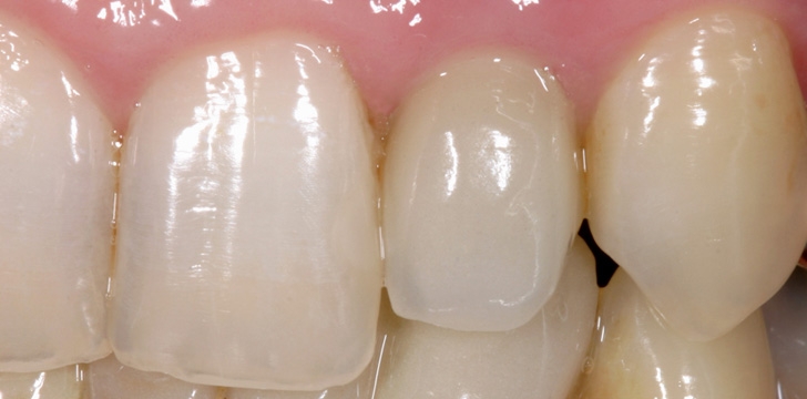 implantatkrone_6-.jpg